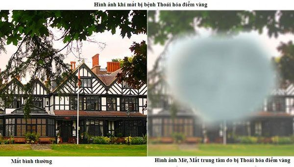 Những dấu hiệu nhận biết thoái hoá điểm vàng